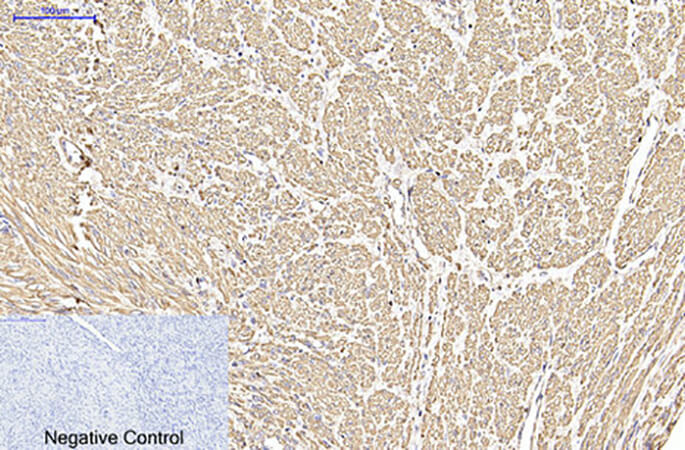 Fig.5. Immunohistochemical analysis of paraffin-embedded human uterus cancer tissue. 1, α-SMA Monoclonal Antibody  was diluted at 1:200 (4°C, overnight). 2, Sodium citrate pH 6.0 was used for antibody retrieval (>98°C, 20min). 3, secondary antibody was diluted at 1:200 (room temperature, 30min). Negative control was used by secondary antibody only.